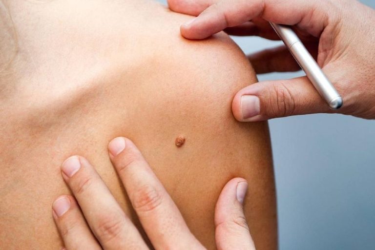 Tigre lanzó una campaña para prevenir el cáncer de piel