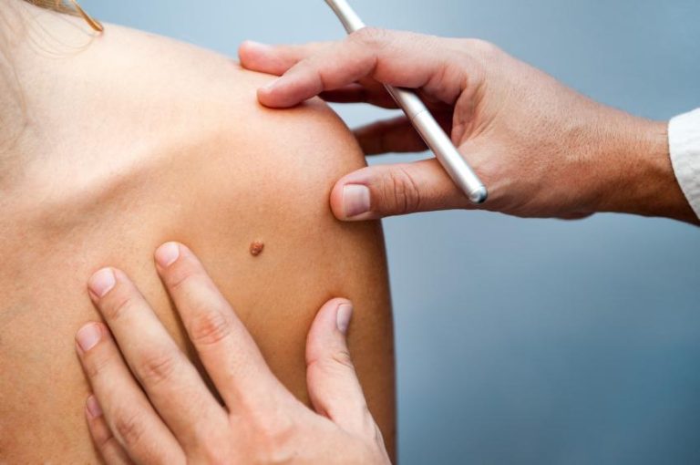Ituzaingó realiza una campaña de prevención del cáncer de piel