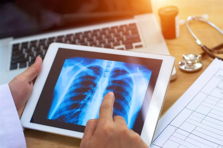 Presentan en la Argentina un nuevo tratamiento para un tipo de cáncer de pulmón