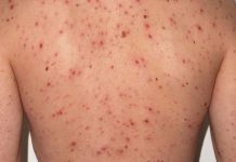 Alarma en el AMBA por casos de Sarampión